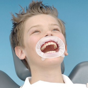 OptraGate Junior детский, 1шт.,  Ivoclar