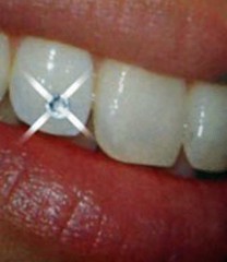 Скайсы 2,4 кристальные (5 шт)  Ivoclar